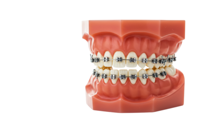 Dental model with braces isolated on transparent background showcasing orthodontic treatment and teeth alignment for a healthy smile and improved oral care