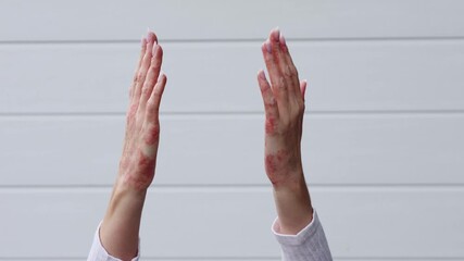 Discover effective ways to manage eczema, psoriasis, and dermatitis for healthier skin