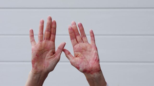 Eczema and psoriasis skin issues affecting hands in daily life