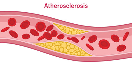 Atherosclerosis. Buildup of plaque in the walls of artery. Arteriosclerotic vascular disease. Medical illustration. 