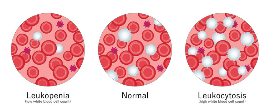 Leukocytosis and Leukopenia. High white blood cell count and low white blood cell count. White blood cell disorders. Medical illustration.