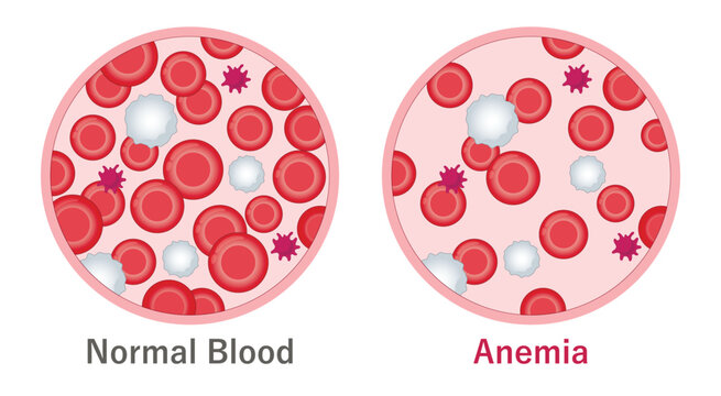 Normal blood and anemia. Low amount of red blood cells. Medical illustration. 