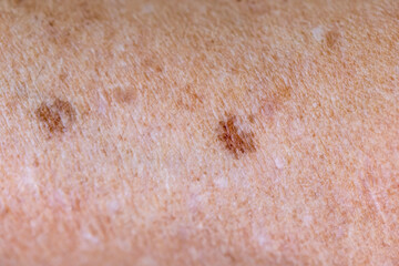 Freckles Over Asian Woman Face,Skin Problems