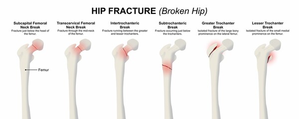 Hip Fracture (Broken Hip) Bone Flashcard Illustration