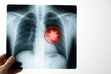 Chest x ray showing highlighted area for cancer awareness with red circle indicating possible lung tumor in center of lungs, medical diagnosis and healthcare concept