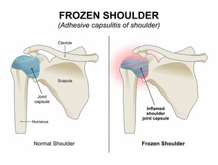 Frozen shoulder - Adhesive capsulitis of shoulder