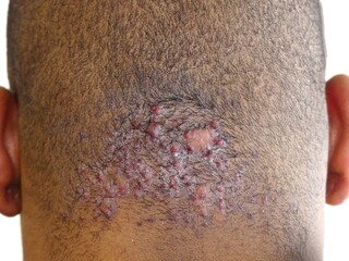 severe acne, folliculitis keloidalis inflammation of hair follicle that affects the nape of the neck