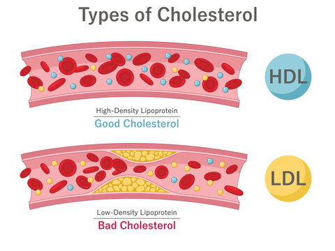 Good and bad cholesterol HDL and LDL. High-density lipoprotein vs low-density lipoprotein. Health education diagram. Medical illustration.