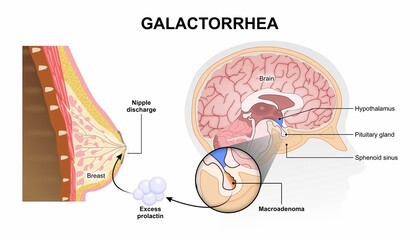 Galactorrhea flashcard breast and brain illustration