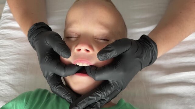 Closeup top view child face during osteopathy therapy. Doctor in black latex gloves presses cranial points on upper palate inside mouth and holds points around nose and jaw while boy lies calm.