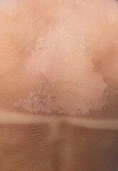 The back is sunburned and peeling. Selective focus.