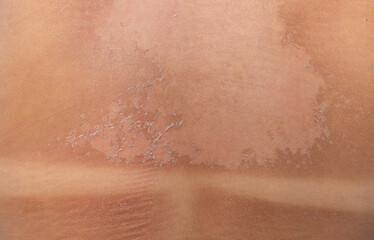 The back is sunburned and peeling. Selective focus.