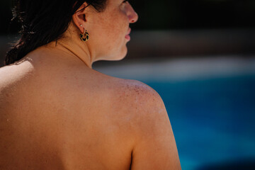 Close-up of a woman’s sun-kissed back and shoulder near a swimming pool, showing sunburned skin,...