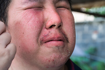 Naklejka premium A close-up of a person's face suffering from a severe skin condition, with red, flaky patches. The image is a medical or conceptual photo of a health issue.