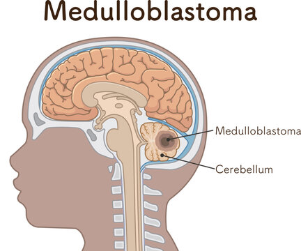 小児 こどもの脳腫瘍　Childhood brain tumors