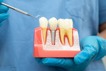 Dental implant, artificial tooth roots into jaw, root canal of dental treatment, gum disease, teeth...
