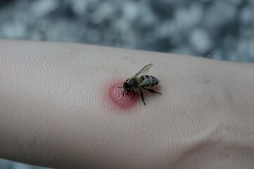 Obraz premium Bee sting on swollen hand with honeybee on skin closeup 