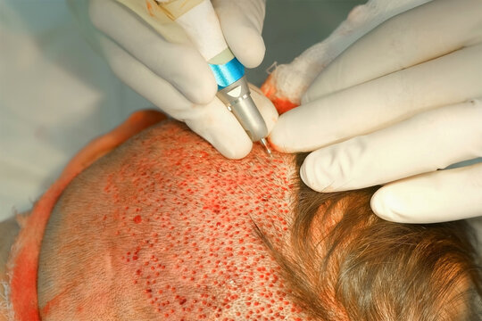 Surgeon cuts out hair grafts from patient head nape using punch to hair transplant. Problem of baldness of men in middle age, treatment of alopecia by hair transplantation surgery in clinic hospital.