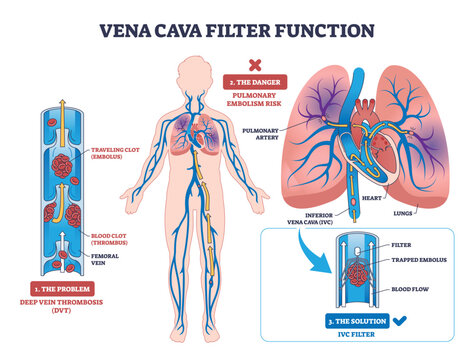 Vena cava filter diagram shows blood clot prevention in veins, highlighting filter, blood flow, and clot. Outline diagram