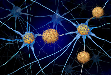 Tau Tangles And Amyloid Beta concept as abnormal clusters of protein fragments that accumulate between nerve cells and inside neuron cells in the brain resulting in degenerative disease as Alzheimers 