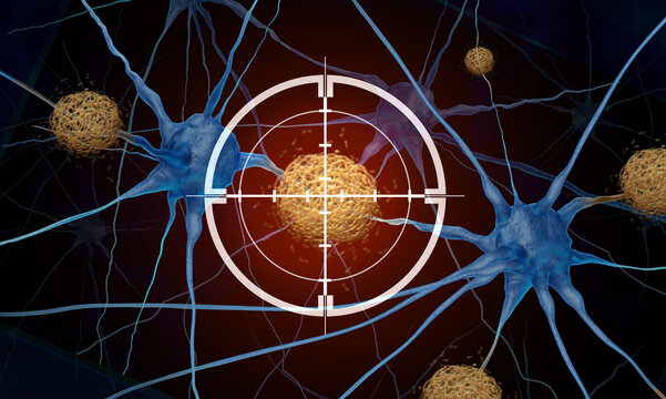 Dementia Treatment concept as Tau Tangles Amyloid Beta therapy as Alzheimers medicine to remove abnormal clusters of protein fragments that accumulate between nerve cells in the brain resulting in deg