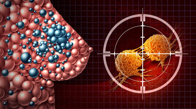 Breast Cancer or Carcinoma of the breast Treatment and mammary Oncology Medical Science fighting Cancer and malignant tumors with surgical removal or radiation treatment to eliminate cancerous cells a