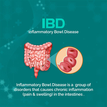 IBD
Inflammatory Bowl Disease
Inflammatory Bowl Disease is a group of disorders that causes chronic inflammation (pain & swelling) in the intestines.