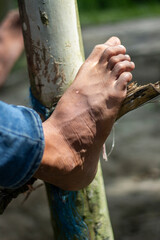 Closeup of a persons foot with dry, cracked skin resting on a pole