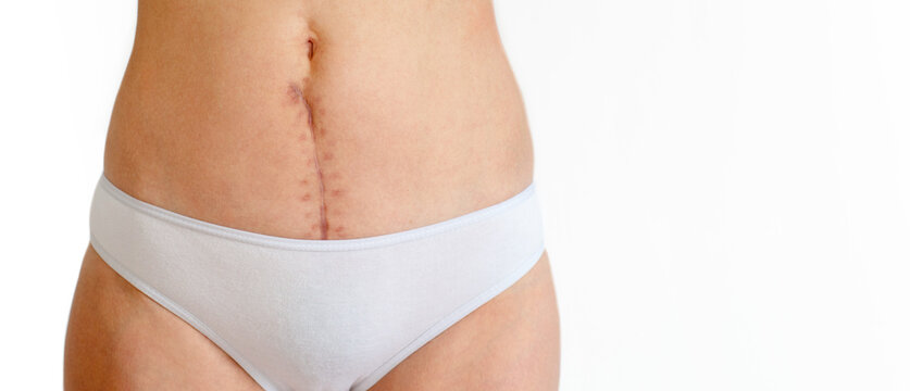 Woman's body with a scar on her abdomen from a surgical suture five months after gynecological surgery (hysterectomy), or after giving birth by cesarean section, close-up, copy space.