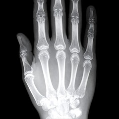 X-ray of a hand (2)