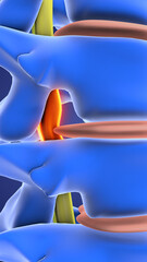 Spinal Decompression Concept for Back Pain Relief