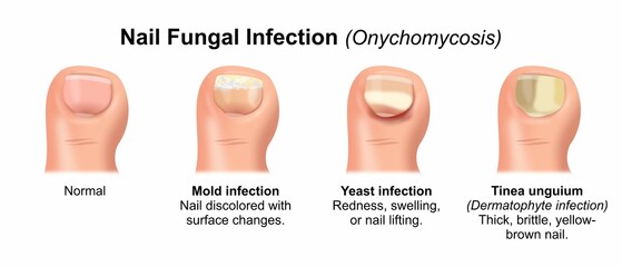 Nail Fungal Infection (Onychomycosis) flashcard