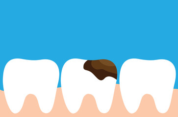 Row of Teeth one Tooth with Cavity Flat Style. Health care and medicine concept vector art, visiting dentist