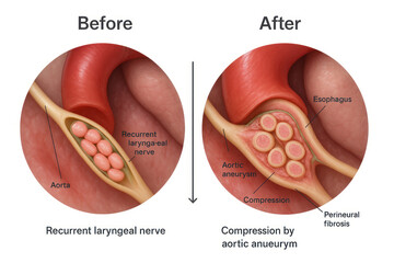 Aortic Aneurysm Impact on Recurrent Laryngeal Nerve