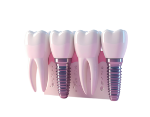 Dental implants in a dental arch