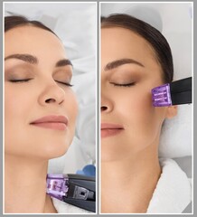 Radiofrequency skin lifting of beautiful patient in beauty salon to improve elasticity and tightening of her neck skin, photo collage. RF lifting