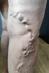 close-up of leg with prominent varicose veins and fair skin tone in indoor medical setting ideal for healthcare education, vascular clinic marketing, medical research, and wellness promotion