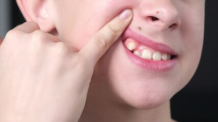 A boy or teenager demonstrates an abnormally grown canine tooth. Demonstration video for dentists.