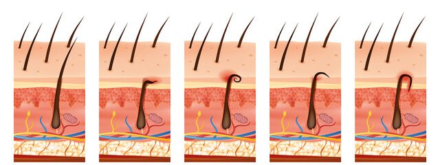 Different types of ingrown hairs in human skin cross-section. Illustration presents normal hair growth, hair trapped under the skin, curling back into the dermis, and inflamed ingrown hair. 