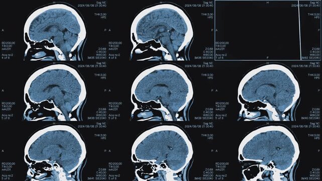 Magnetic resonance images of the head, MRI of the brain, side and top viev of a patient with multiple vascular infarctions,1 image and 3x3 grid, monochrome animation Seamless Loop
