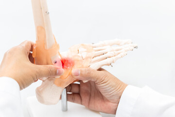 Orthopedist explain to the patient for human foot bone injury treatment program.Doctor showing to feet fingle bone anatomy and ligaments pain.Physiotherapy present foot model for injured athlete.