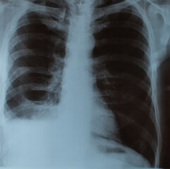 chest X-ray