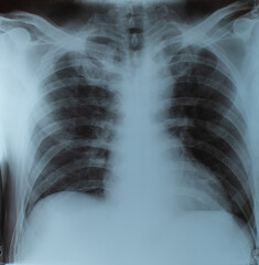 chest X-ray