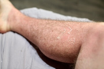 Fototapeta premium Close-up of leg shows peeling skin from sunburn. Bright light highlights desquamation. Neutral background contrasts inflamed skin, emphasizing texture and condition