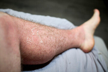 Close-up of sunburned leg with visible peeling. Indoor setting with soft lighting highlights texture. Redness contrasts with light towel background, depicting desquamation process