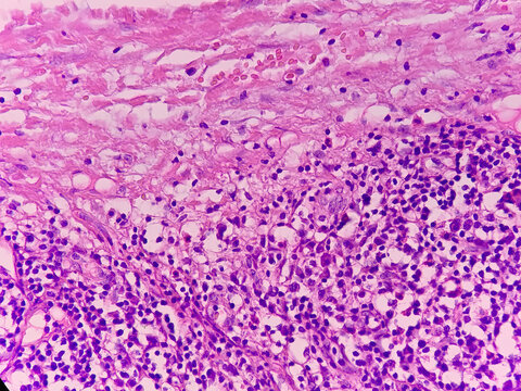 Hodgkin's lymphoma