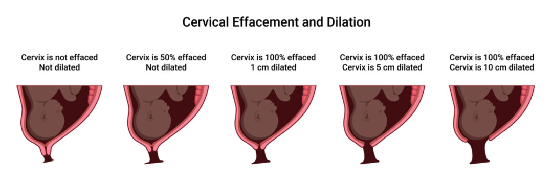 Cervical Effacement and Dilation. Various processes in the Uterus during Childbirth. Thinning and shortening of the Cervix. Detailed medical vector illustration. The fetus is in the uterus
