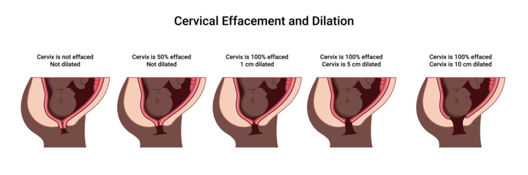 Cervical Effacement and Dilation. Various processes in the Uterus during Childbirth. Thinning and shortening of the Cervix. Detailed medical vector illustration. The fetus is in the uterus
