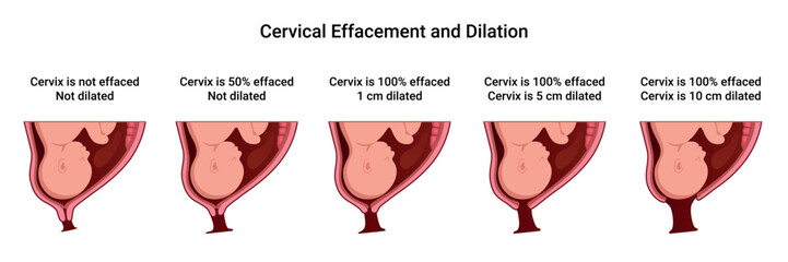 Cervical Effacement and Dilation. Various processes in the Uterus during Childbirth. Thinning and shortening of the Cervix. Detailed medical vector illustration. The fetus is in the uterus
