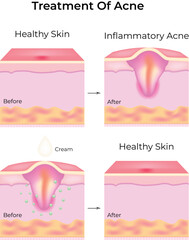 Acne Treatment Process From Inflammatory Acne to Healthy Skin Vector Illustration